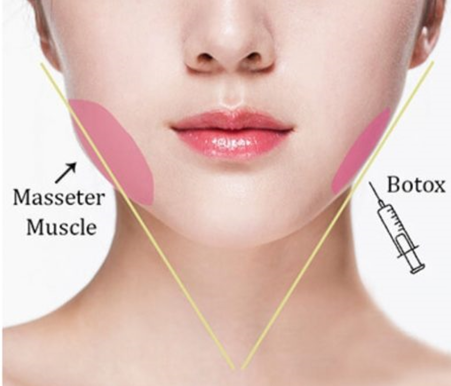 Botox Masseter – Clenching, Grinding, & Face Slimming