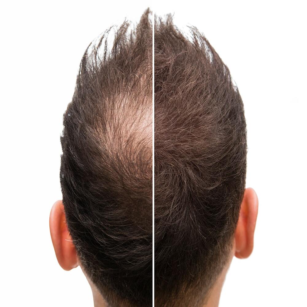 PRF Hair Restoration Full Treatment - Just $1695!